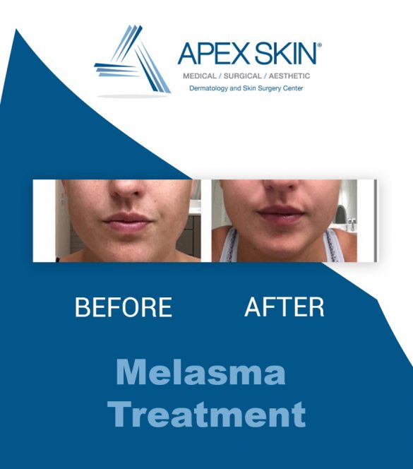 Before and after Melasma treatment