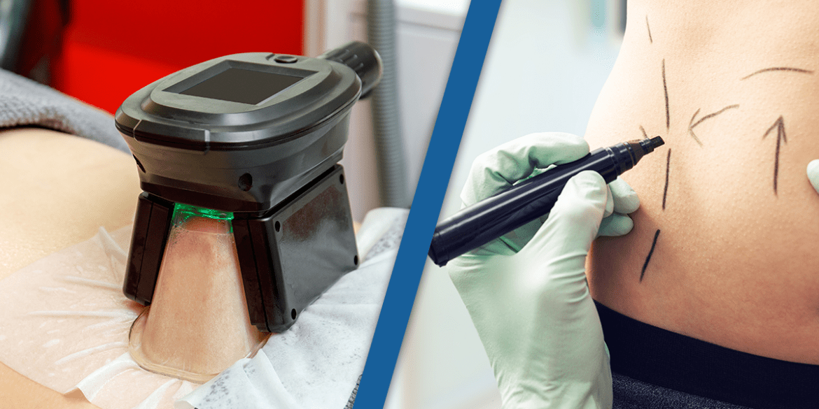 coolsculpting vs lipo