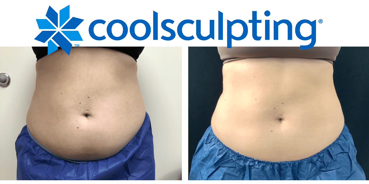 Meet Elite: Get Better & Faster Results with the New in CoolSculpting Innovation - The Women's Journal