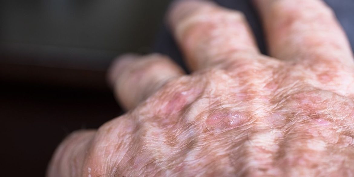 skin conditions apex skin