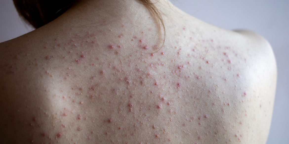Woman Back With Acne, Red Spots, Skin Disease Woman back with acne red spots